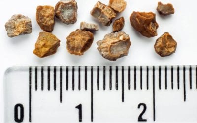 High and dry Colorado ripe for developing kidney stones