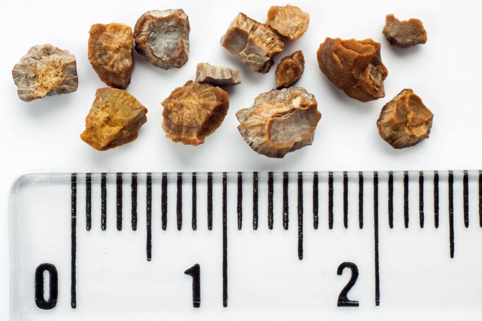 High and dry Colorado ripe for developing kidney stones