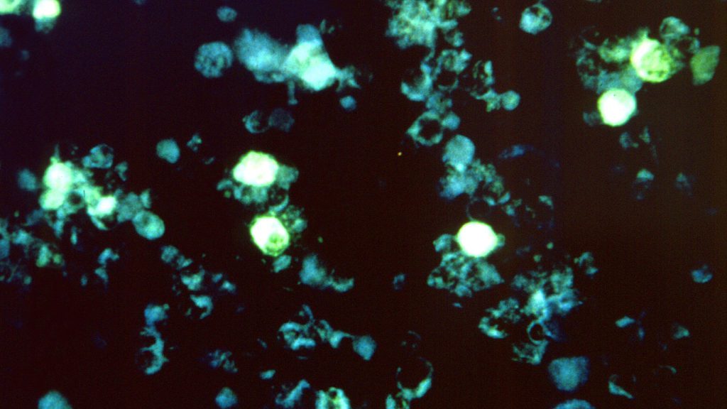 Strong new evidence suggests a virus triggers multiple sclerosis – STAT