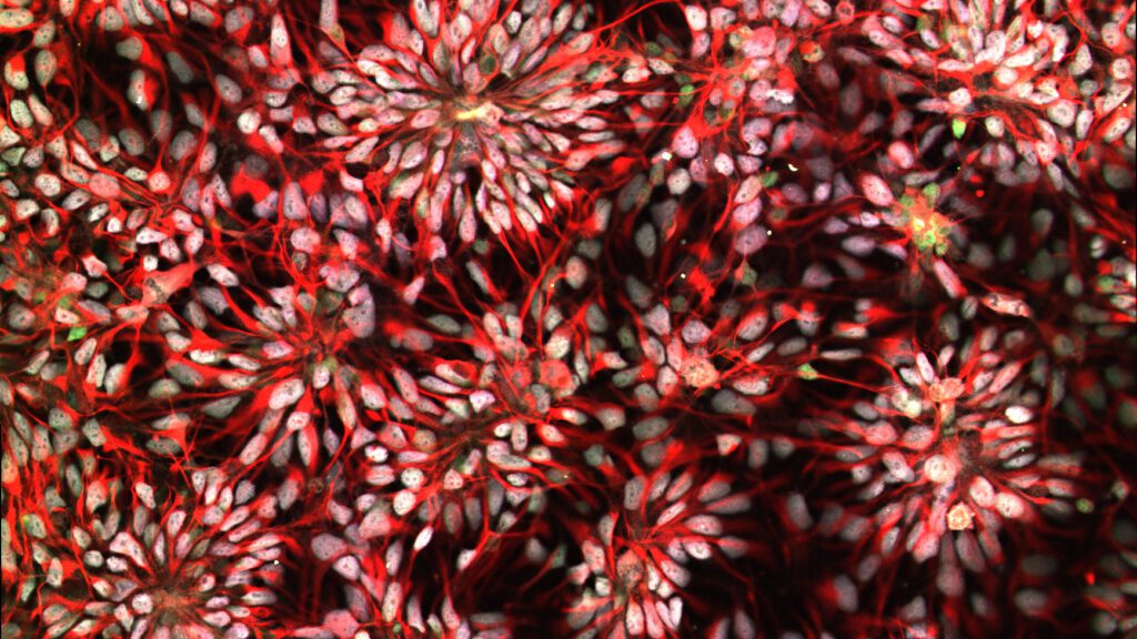 Study suggests new cause of Down syndrome: cells linked to aging – STAT